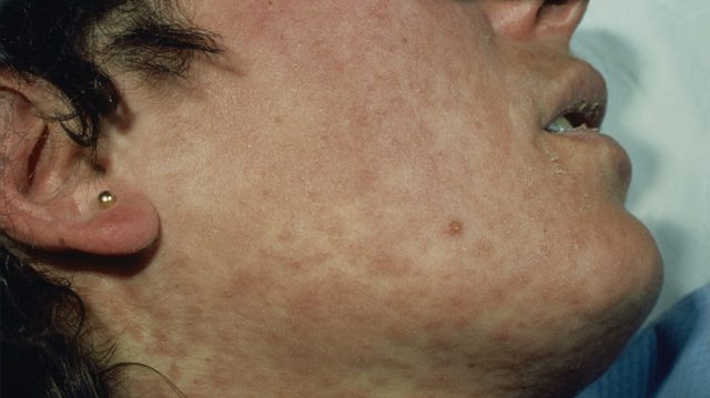 US measles cases hit 35-year high