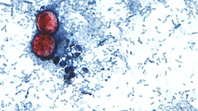 First two US deaths linked to diarrhea-inducing parasite confirmed