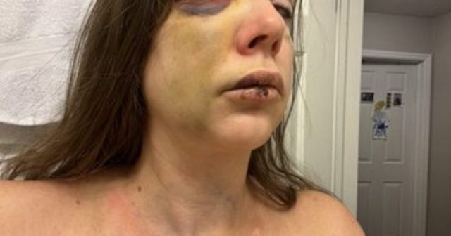 Cincinnati Mob Violence Victim Holly Breaks Her Silence, Reveals She is Suffering “Very Bad” Brain Trauma (VIDEO)